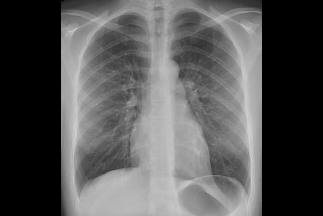 A chest X-ray: two large dark lungs either side of the pale spine and heart, framed by the curved white ribs.