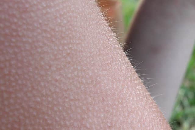 Close-up of goosebumps on a person’s arm: tiny raised bumps across the skin, with fine hairs standing up along the edge.